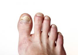 what causes toenails to turn yellow