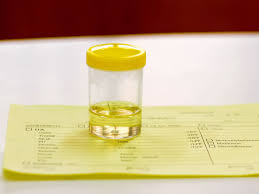 Cortisol Urine Test Purpose Types And Results