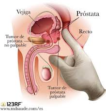 cáncer de próstata qué es síntomas y