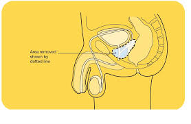 Treatment for bladder cancer depends on your overall health, progression of the c. Management And Treatment Of Prostate Cancer Cancer Council Victoria
