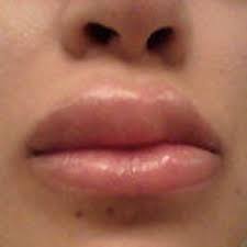 extreme swelling in top lip after