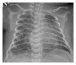 Rds stands for respiratory distress syndrome. it is the most common lung disease in premature infants and it occurs because the baby's lungs are not fully developed. Http Iaimjournal Com Wp Content Uploads 2017 12 Iaim 2017 0412 03 Pdf