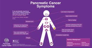 Learn more about the symptoms and treatments here. Pancreatic Cancer Lessons Blendspace