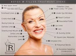 Image Result For Botox Injection Map In 2019 Botox