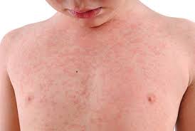 hives or urticaria in children
