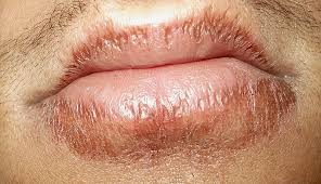 chapped lips are one of the signs of
