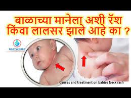 remes for baby s neck rash