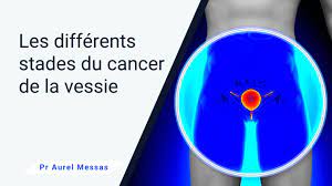 Les différents stades du cancer de la vessie - Pr Aurel Messas