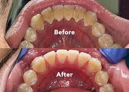 deep cleaning teeth cost how much
