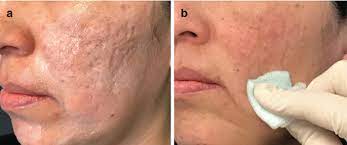 acne scar hyaluronic acid filler