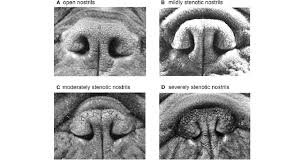Definition Of The Degree Of Nostril Stenosis In