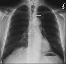 Check spelling or type a new query. Did I Miss That Subtle And Commonly Missed Findings On Chest Radiographs Sciencedirect