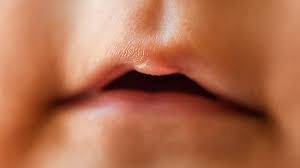 blister on baby lip causes treatments
