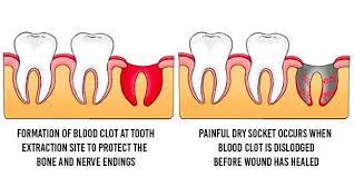 The amount of postoperative rest and recuperation you require following your after you've had a tooth pulled, it's the healing of the hole in your jawbone (the tooth's socket) that takes the greatest amount of time (as opposed to your gum. How Long Does It Take The Hole To Close After Tooth Extraction