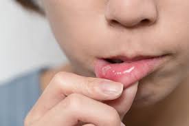 what are canker sores and how to heal