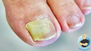 damaged big toenail completely lifted