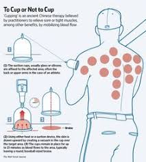 22 Best Cupping Therapy Images Cupping Therapy Therapy