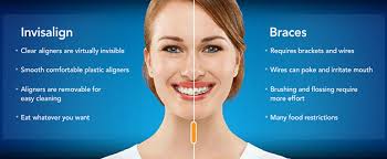 Invisalign Aligners For Teens Invisalign Teen Philadelphia