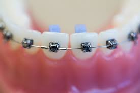 what to do if your braces have broken