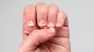 your nails it may be an autoimmune disease