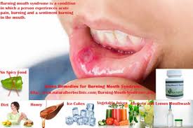 burning mouth syndrome symptoms gifyu
