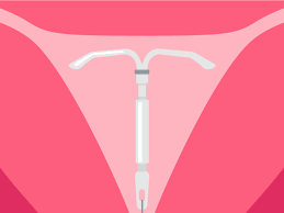 Since many insurance plans require you to pay at least $1,000 in medical expenses before coverage kicks in, the average woman getting an iud would have to pay nearly the entire cost, making what doctors say. Iud Removal Ob Gyn Experts Explain What To Expect Self