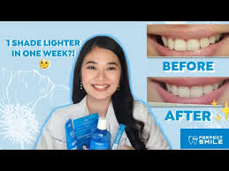 teeth whitening in just 7 days