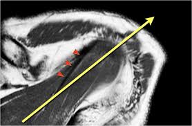 In flat foot deformity both the tendon and the spring ligament can be injured. The Radiology Assistant Shoulder Anatomy Mri