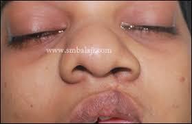 cleft rhinoplasty surgery in india