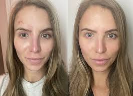 aviclear laser for acne my before and