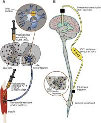 als a disease of motor neurons and