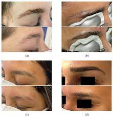 laser removal of cosmetic eyebrow