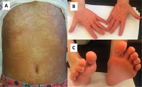 widespread maculopar rash