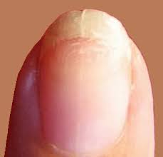 my fingernails split down the middle
