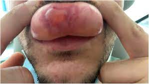 lip angioedema after indirect contact