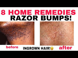 stop ingrown hairs or razor ps