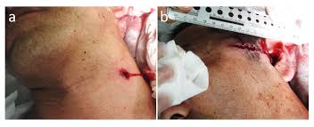 Even just on your face, the skin on your upper lip is 50% thicker than the skin on your cheek, . Atypical Gunshot Injury To The Neck With An Unexpected Nonlinear Bullet Trajectory A Case Report And Review Of The Literature Research Square