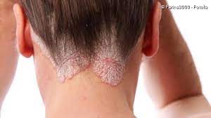 Ernsthafte schädigungen der haarfollikel ; Hautkrankheiten Welche Gibt Es Netdoktor