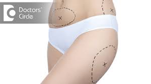 how much weight loss can be expected after liposuction dr girish a c