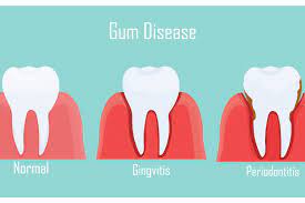 natural treatment for gum diseases