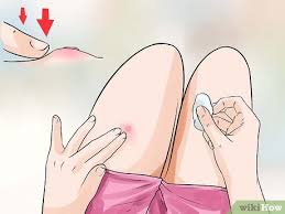 how to pop a boil 7 steps with
