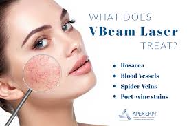 vbeam laser for face your ticket to a