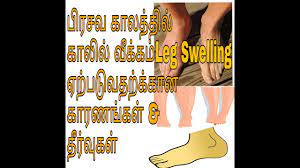 natural home remedy for leg swelling