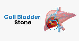 how risky is gallbladder stone gallstones