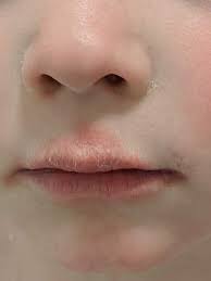 what is wrong with sons lips with pic