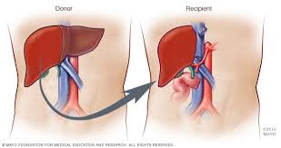 Liver Transplant Mayo Clinic