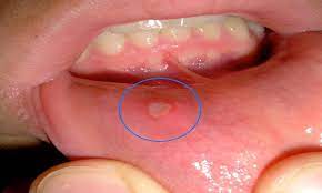 diabetic ulcers in the mouth and other