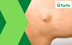 abscess vs cyst what s the difference