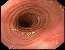 Eosinophilic Esophagitis child  ile ilgili görsel sonucu