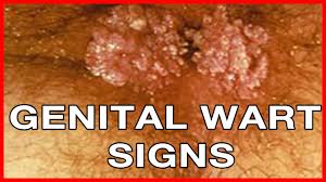 how to recognize warts signs